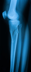Broken leg x-ray image, lateral view, showing upper tibia fracture