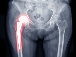 x-ray Both hip  ap view