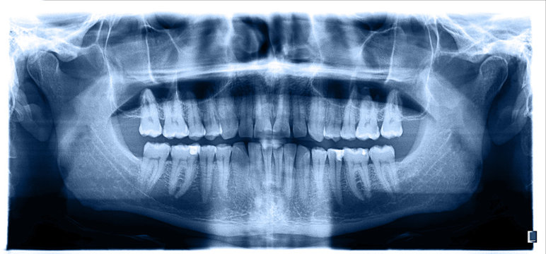 Close up. Panoramic image of the jaw, primary adentia of the third molar. Medical examination of teeth, maxillofacial surgery.