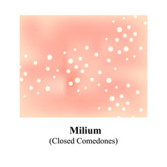 Miliums, closed comedones, Skin with blackheads. Black spots. Acne on the skin. Infographics. Vector illustration.