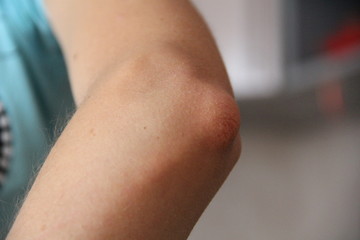 Part of a young girl's hand. Elbow