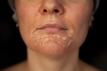 Woman's face after chemical peeling. Peeling skin on the face. Exfoliation of old skin. Facial...