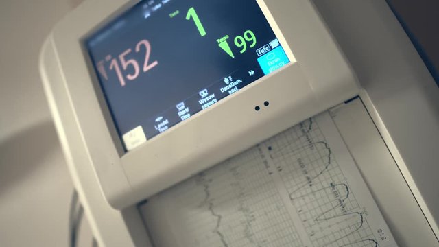 Labor Ward Cardiotocography Monitor Used In A Maternity Hospital To Record The Fetal Heartbeat And Uterine Contractions During Pregnancy - Closeup Shot