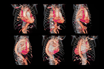 Collection  of CTA thoracic aorta  3D rendering image for  diagnotic abdominal aortic aneurysm or AAA and aortic dissection - obrazy, fototapety, plakaty
