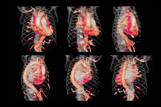 Collection  of CTA thoracic aorta  3D rendering image for  diagnotic abdominal aortic aneurysm or AAA and aortic dissection
