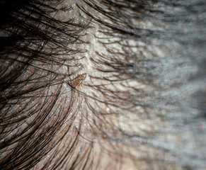 Louse egg on the hair causes itchy head.