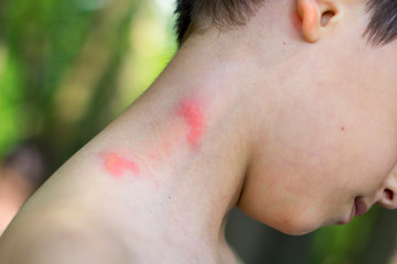 Fototapeta premium insect bites on a little boy's neck