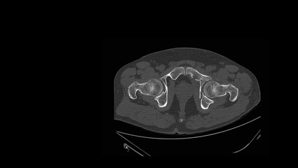 CT scan(computed tomography)hip radiograph show broken hip bone or fracture acetabulum(acetabular...