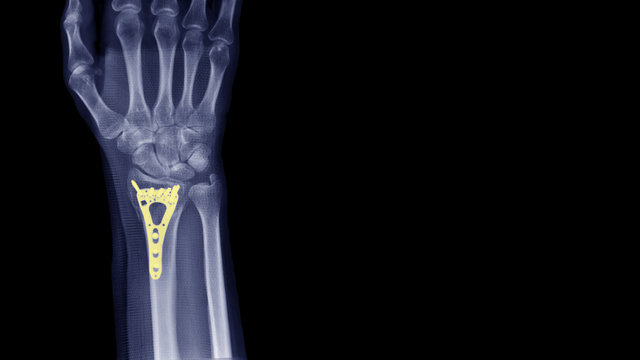 Film X-ray wrist radiograph show lower end of forearm bone broken (distal end radius fracture) treatment by plate fixation surgery (ORIF operation). Orthopedic implant and medical technology concept.