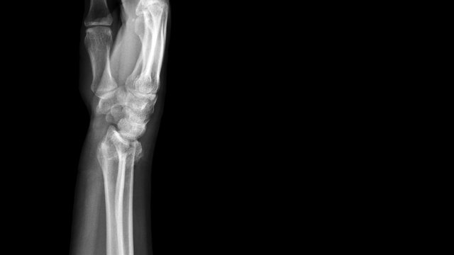 Film X ray wrist radiograph show distal forearm bone broken ( distal end radius fracture). The patient has wrist pain, swelling and deformity. Medical imaging for investigation and technology concept