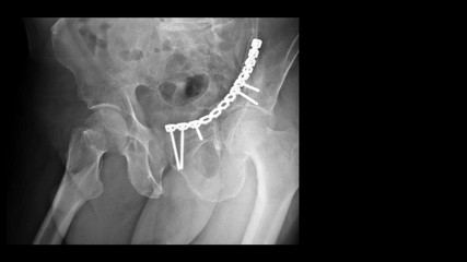 Film X ray hip radiograph show broken hip bone or acetabular fracture disease treated by open...
