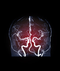  MRA brain or Magnetic resonance angiography image ( MRA ) of cerebral artery in the brain coronal...