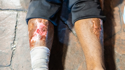 A man with a leg wound sitting on the floor of Thailand