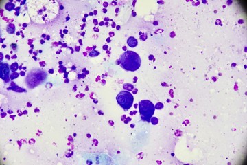 Mononuclear and multinucleated cell (Tzanck smear ,Abnormal Human cells , Medical technologist)