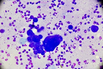 Mononuclear and multinucleated cell (Tzanck smear ,Abnormal Human cells , Medical technologist)