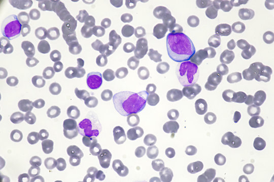 White blood cell (Normal and Abnormal White blood cell)