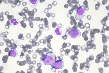 Blast cell (Acute myeloid leukemia in Human)