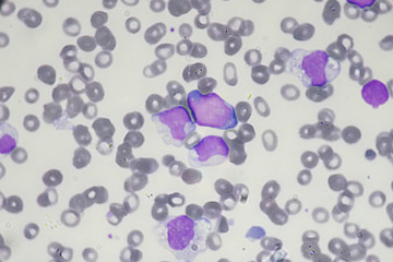Blast cell (Acute myeloid leukemia in Human)