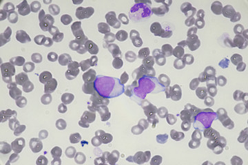 Blast cell (Acute myeloid leukemia in Human)