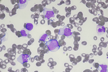 Blast cell (Acute myeloid leukemia in Human)
