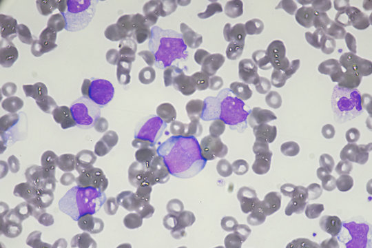 Blast Cell (Acute Myeloid Leukemia In Human)