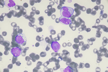 Blast cell in Acute myeloid leukemia from human blood cells (White blood cells cancer , Bone marrow aspirate)