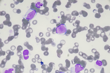 Blast cell in Acute myeloid leukemia from human blood cells (White blood cells cancer , Bone marrow aspirate)