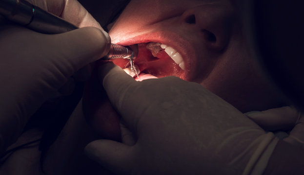 treatment of tooth caries, dental  close-up.
