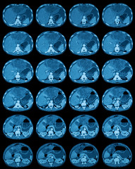 Compute tomography (CT scan) of abdomen, a case of liver mass