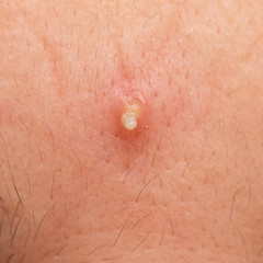 inflamed acne on the skin of the face
