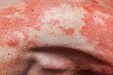Skin allergy to the human body. Abstract damaged skin background.