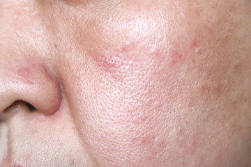 Allergy rash and red blister on woman face closeup