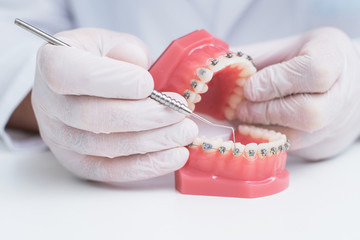 doctor orthodontist shows how the system of braces on teeth is arranged