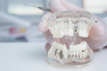 doctor orthodontist holds in his hand a model of teeth with implants