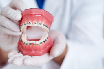 Fototapeta na wymiar doctor orthodontist shows how the system of braces on teeth is arranged