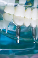 Fototapeta na wymiar Dentist teeth implant dental model