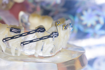 Dental brackets teeth straighteners