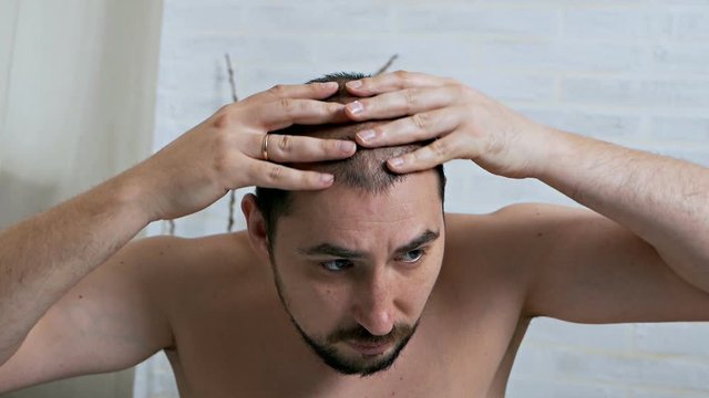 Combating hair loss in men. Injections to the head. Treatment for male pattern baldness. Early hair loss. A man uses a spray for hair growth