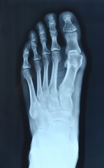 X-ray normal human foot . Top view . 