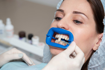 Preparing the oral cavity for whitening with an ultraviolet lamp. Close-up