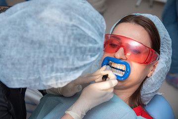 Preparing the oral cavity for whitening with an ultraviolet lamp. Close-up