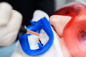 Preparing the oral cavity for whitening with an ultraviolet lamp. Close-up