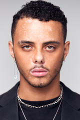 Obraz premium Studio Portrait Of Young Man With Skin Pigmentation Disorder Looking At Camera