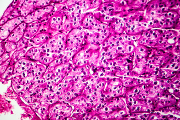Obraz premium Kidney cancer, light micrograph, photo under microscope