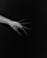 x-ray of hand bones, diagnosis of diseases