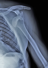 x ray of the shoulder joint with dislocation of the head of the humerus