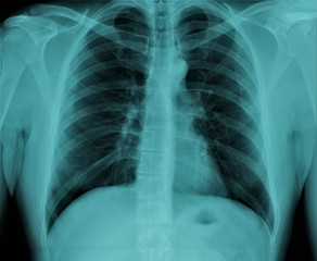 chest x-ray, pneumonia, emphysema, pulmonology, diagnosis of diseases
