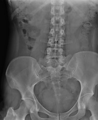 x-ray of the abdominal cavity and pelvis in direct projection, medical research