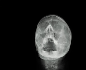 x ray of the paranasal sinuses of the skull, medical diagnosis
