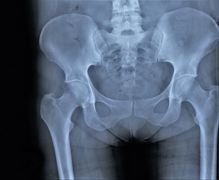 x-ray of pelvic bones and hip joints in direct projection, coxarthrosis, osteoporosis, medical research